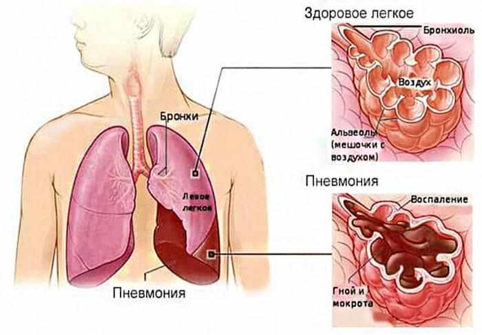 Признаки пневмонии