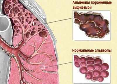 Эмфизема легких
