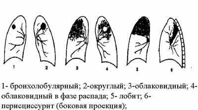 Виды инфильтрации легких