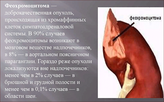Что такое феохромоцитома