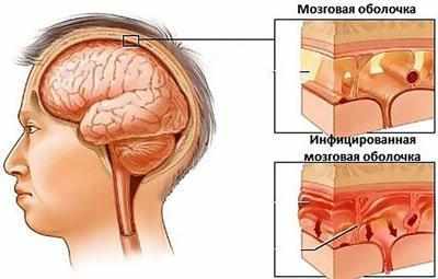 Воспаление оболочки головного мозга