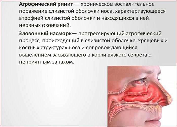признаки атрофического ринита