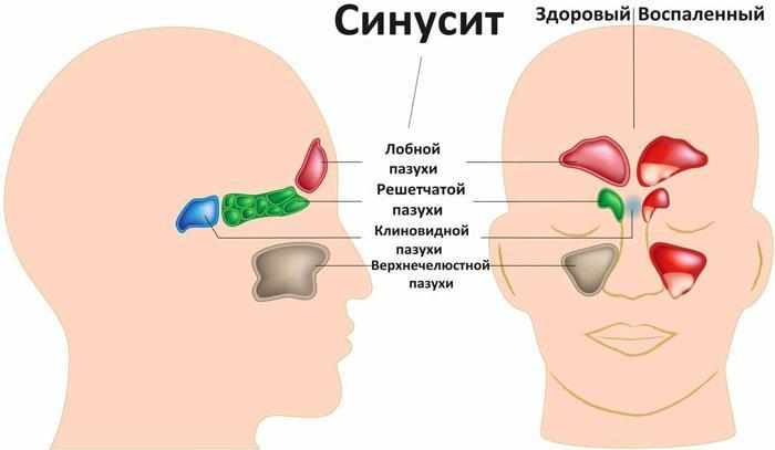 Симптомы синуситов