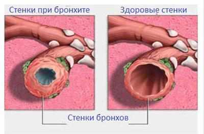Проявление бронхита