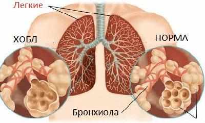 Хронический бронхит