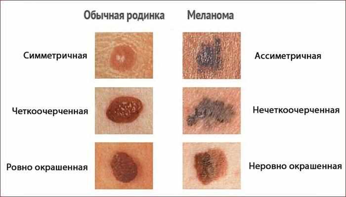 Отличия меланомы от родинки
