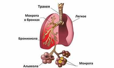 Застойная пневмония