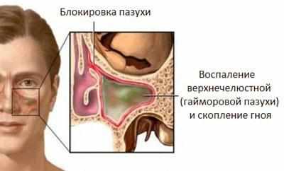 Образование гноя