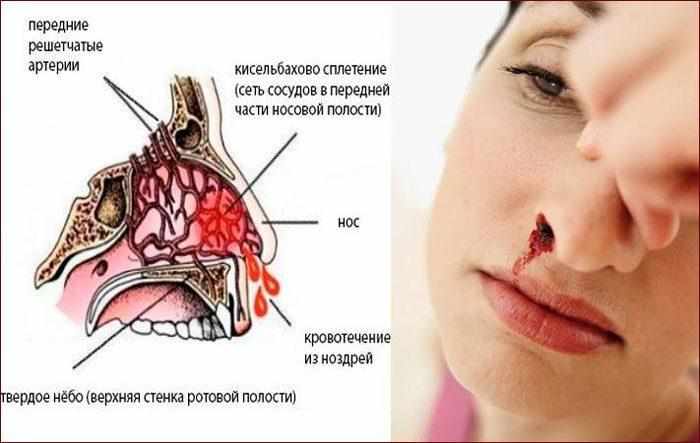 Носовое кровотечение
