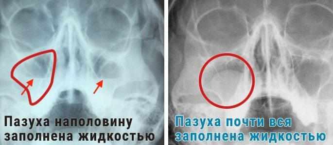 Субтотальное затемнение