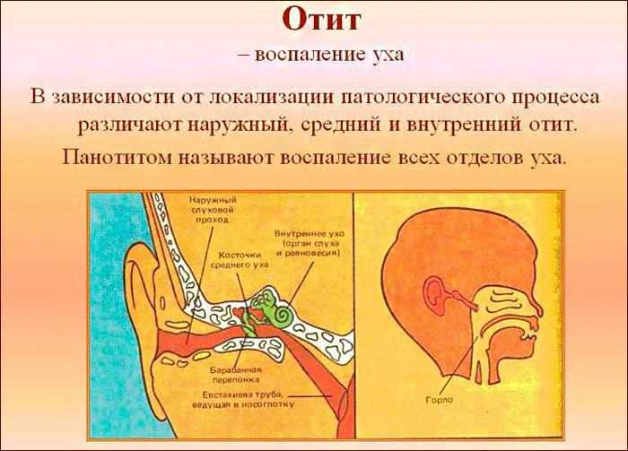 Что такое отит, его симптомы.