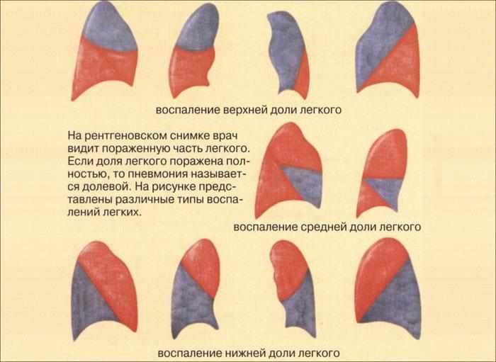 Воспаление врехней, средней и нижней доли легкого