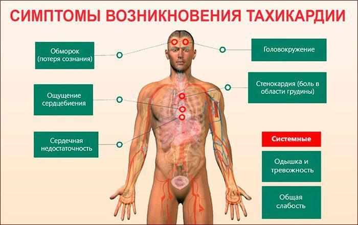 симптомы тахикардии