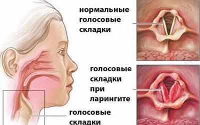 Ларингит у взрослых