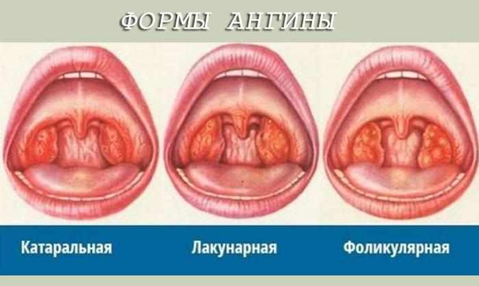 Формы ангины