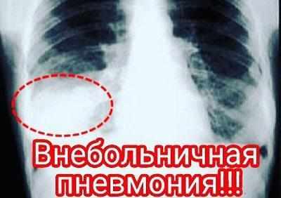 Внебольничная пневмония