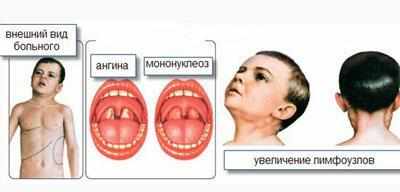Признаки мононуклеоза