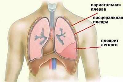 Воспаление плевральной области