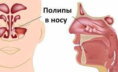 Полипы в носу