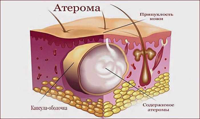 Строение атеромы.