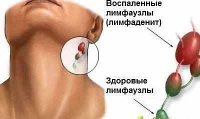 Проявление лимфаденита