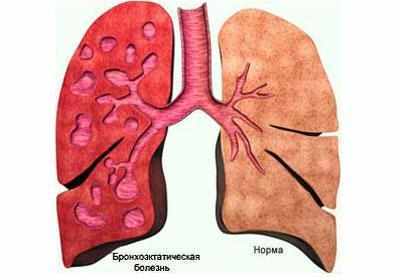 Бронхоэктатическая болезнь