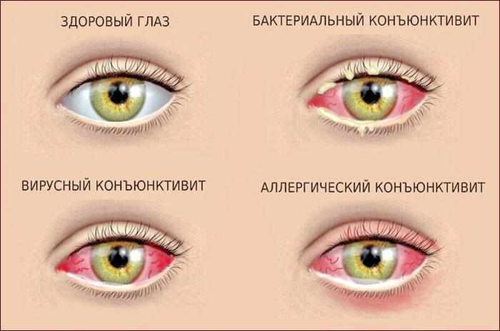 Симптомы конъюктивита