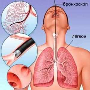 Бронхоскопия