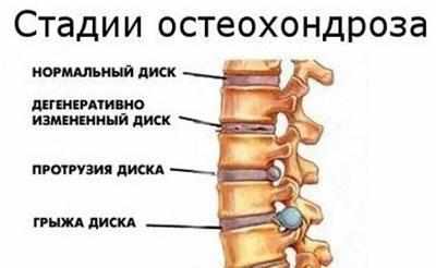 Стадия остеохондроза