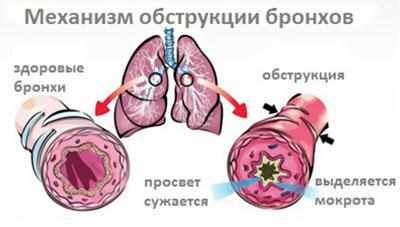 Выделение мокроты