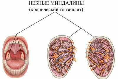 Хронический тонзилит