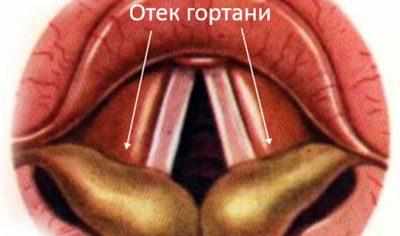 Отек горла