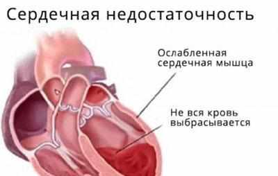Сердечная недостаточность