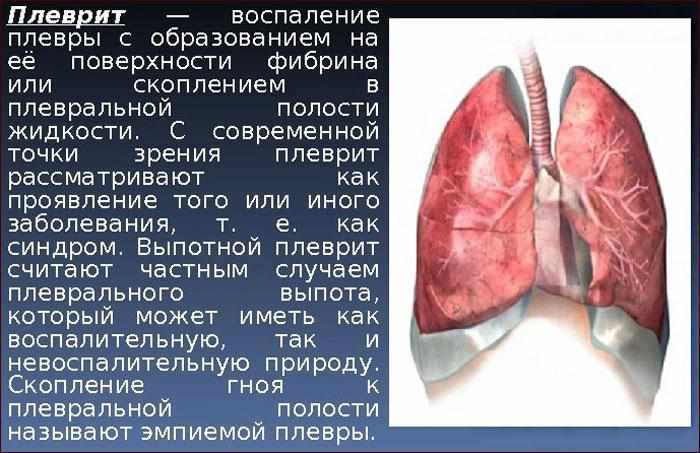 симптомы плеврита