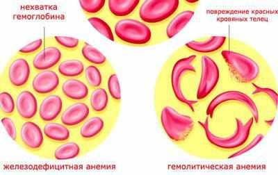 Виды анемии