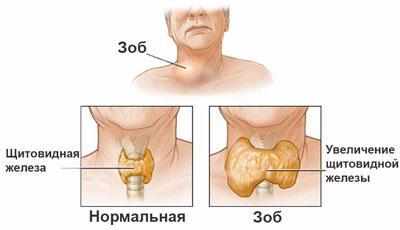 Зоб у человека