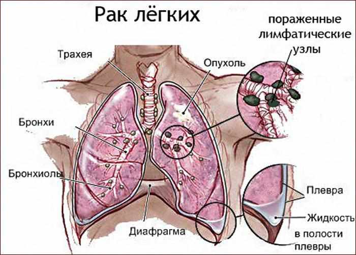 специфика рака лёгких