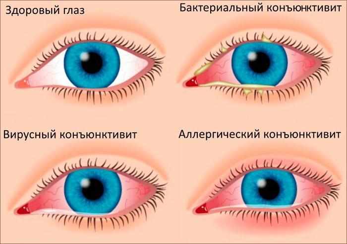 Симптомы конъюктивита