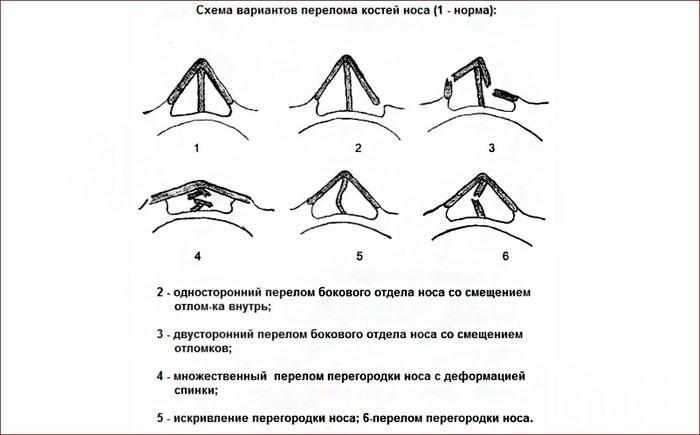 Формы перелома носа