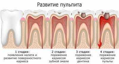 Развитие пульпита