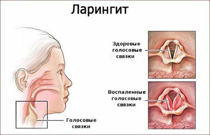 Признаки ларингита
