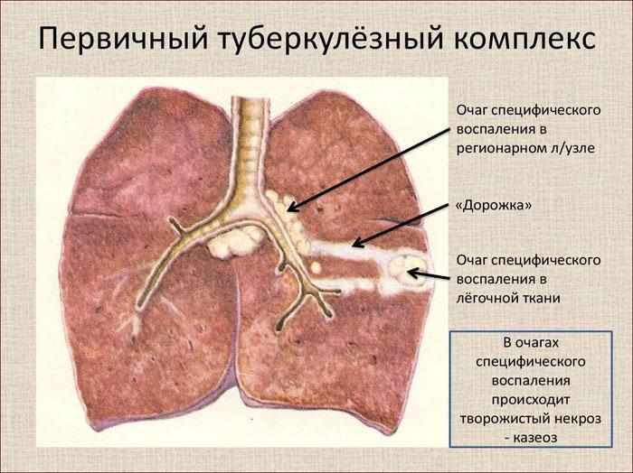 Первичный туберкулезный комплекс
