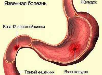 Язвенная болезнь