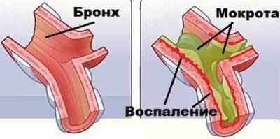 Проявление бронхита