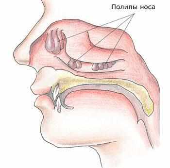 Полипы в носу
