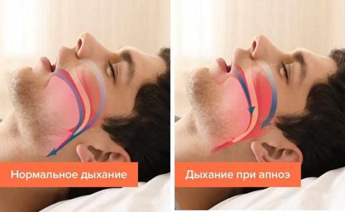 Апноэ