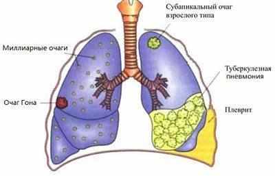 Туберкулез легких