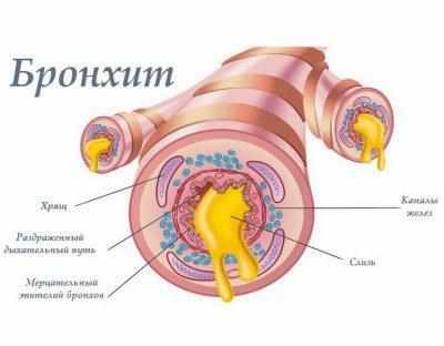 Бронхит 
