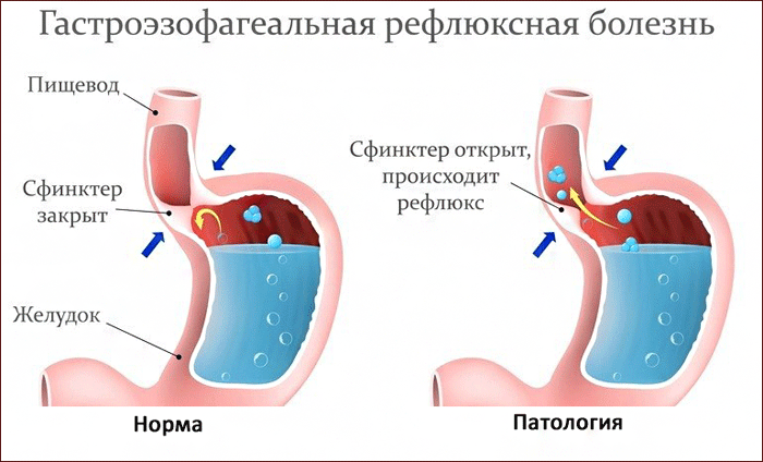 симптоматика изжоги
