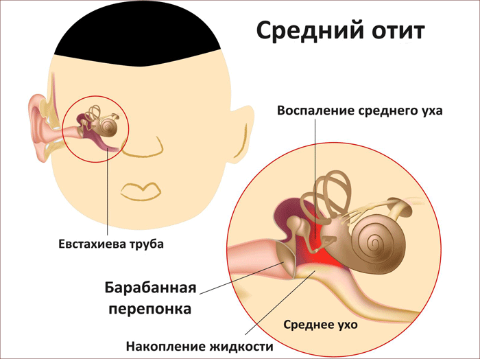 симптомы среднего отита